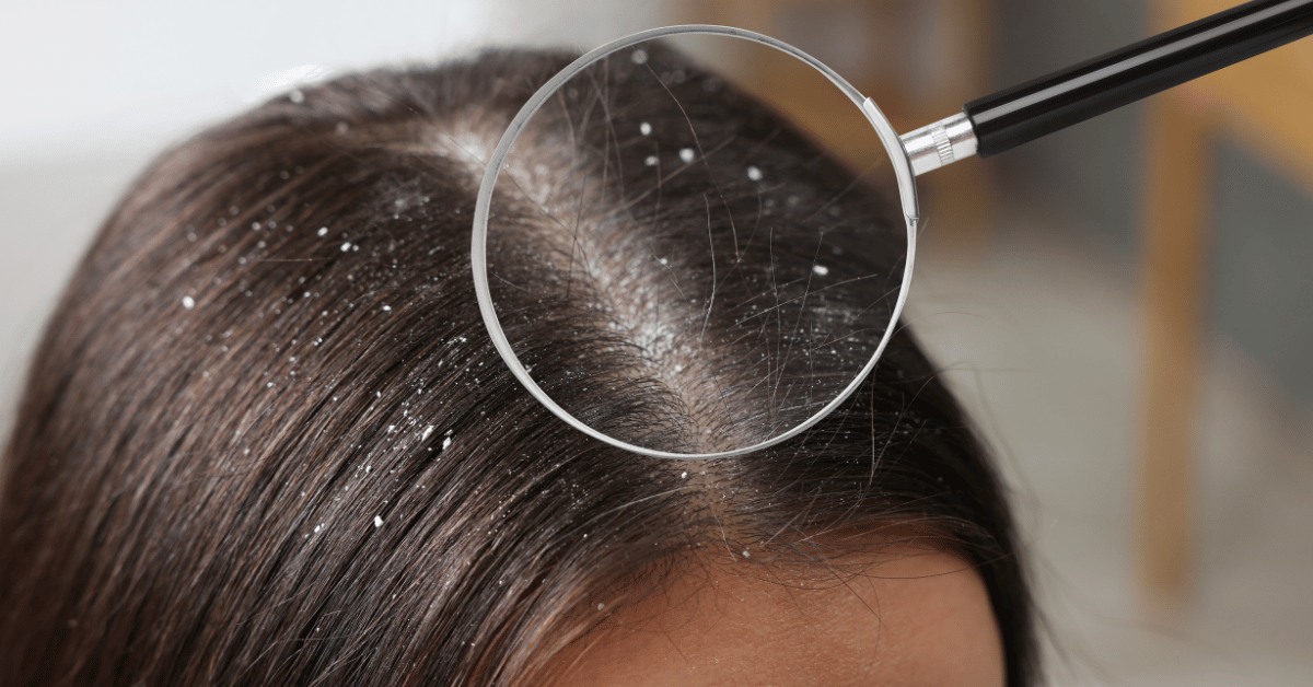 How to Choose an Anti-Dandruff Shampoo for Your Hair Type